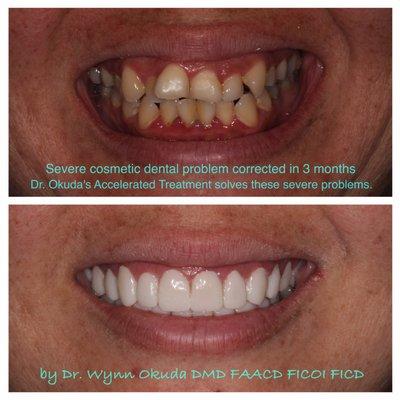 Innovative OKUDA accelerated approach to cosmetic cases... this took less than 3months to get to this point!! #newsmile #aacd #drokuda