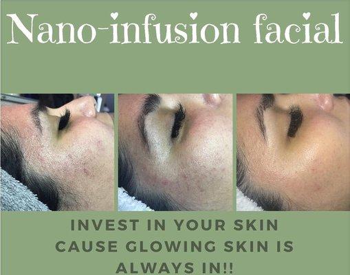 Nano Infusion - microchanneling - infusing products deep into the skin