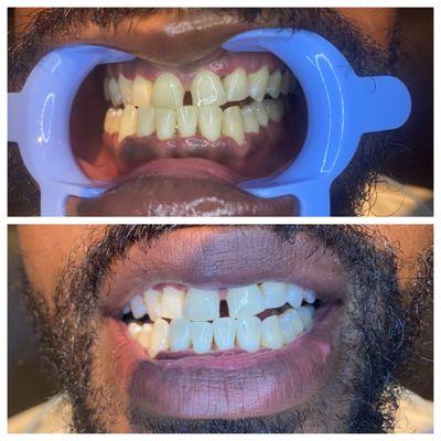 1 hour Teeth whitening session