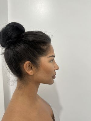 Morpheus 8 treatment on double chin