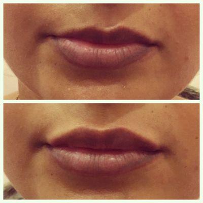 Before and after lip augmentation with Juvederm 1cc