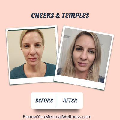 Renew Youth with filler to cheeks