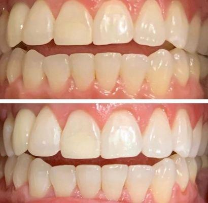 Teeth whitening