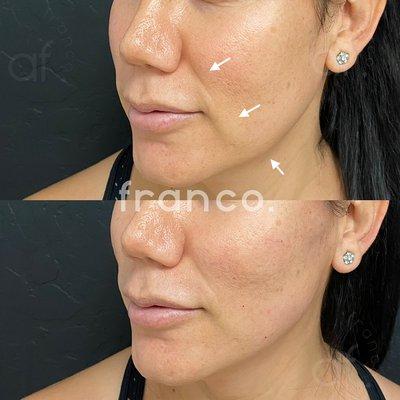 PDO Threadlift for Lower Facelift.