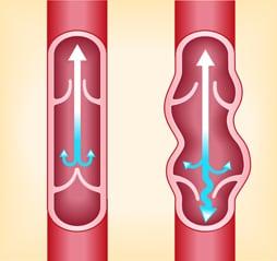 Showing a diseased vein with incorrect blood flow