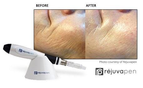 Rejuvanpem Micro-Needling - Anti-Aging Skin Rejuvenation