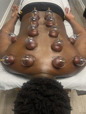 Cupping Therapy For Back Stiffness