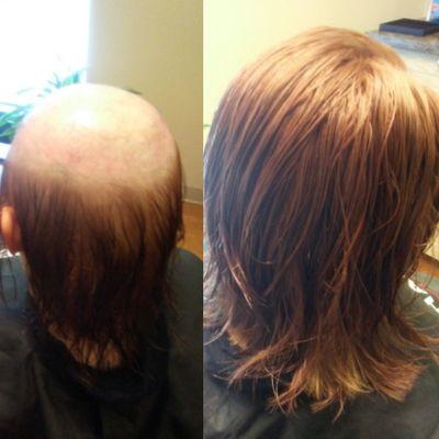 Ex. Hair Replacements HairLoss , Alopecia