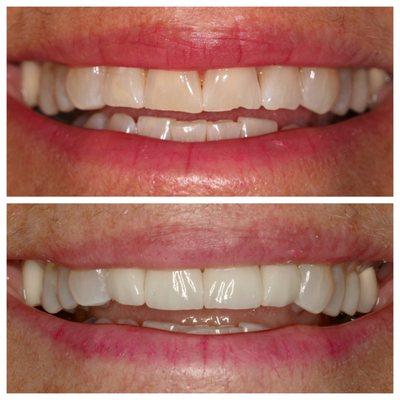 Four veneers to strengthen and brighten her smile