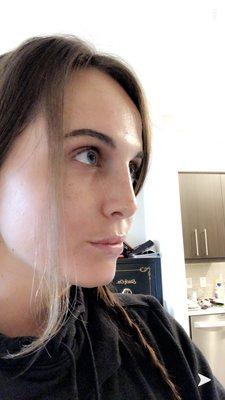 I got a rhinoplasty from Dr. Pestana only a few months ago and my results are incredible.