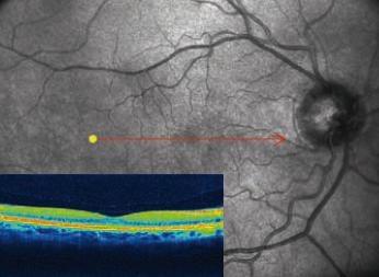 Our new OCT RETINAL test-image