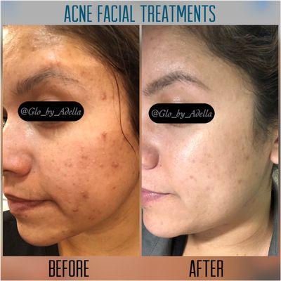 Acne Facial Treatment available