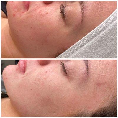 Before and after collagen induction therapy