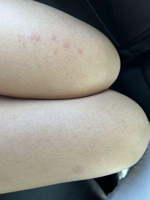 Bed bug bites