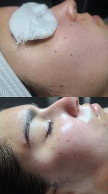 Dermaplane facial.