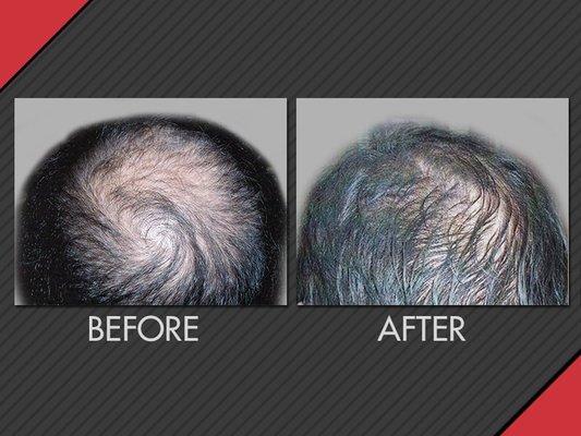 MAXiM Hair Restoration