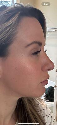 Before microneedling. This makes me want to cry. Bouncier, tighter skin, no pitting, just some visible pores in T-zone.