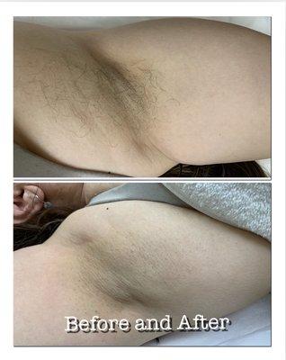 Under arms is one of the best area to treat with laser , after completing 6 treatments you loose almost all your hair permanently!