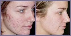 Acne: Before & After Results with Smooth Beam Laser