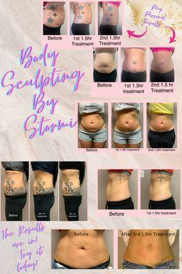 Lose inches with body sculpting