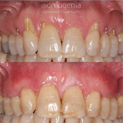 Connective Tissue Graft to treat multiple teeth with root exposure