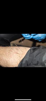 Dry Needling