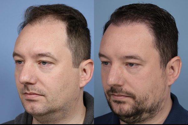 FUE Hair Restoration before and after