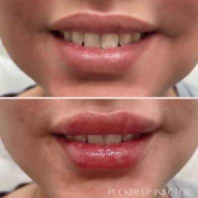 Just 1/2 syringe for this beauty's lip touch-up.  Previously treated with 1ml, we're keeping those lips luscious and natural.