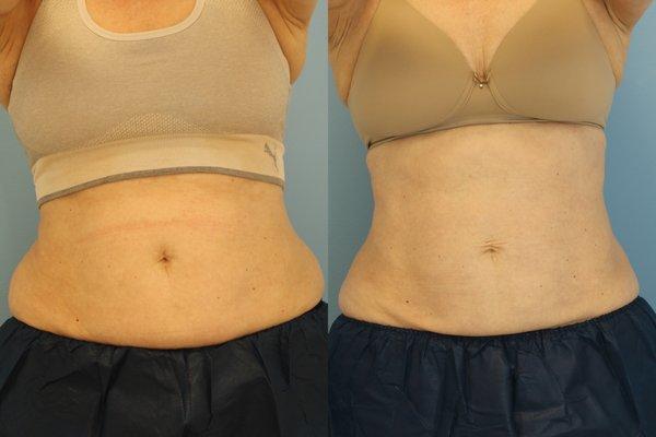 Coolsculpting (Flanks)