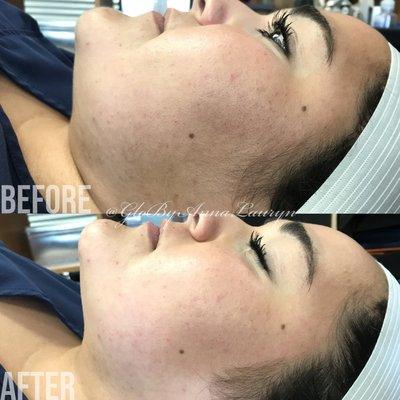 Dermaplaning Facial. Before and After.