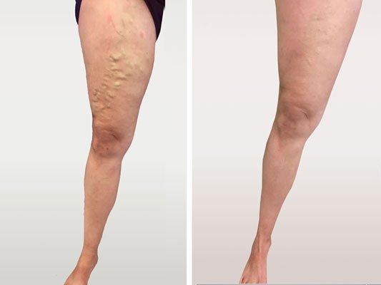 Varicose veins before and after endovenous ablation and sclerotherapy