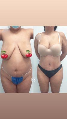 Tummy Tuck and Breast lift from another happy patient . We are proud to have performed over 30,000 procedures