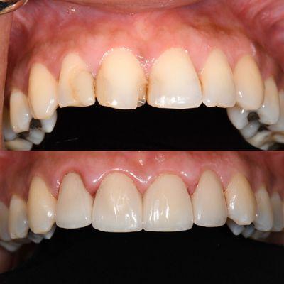 Before and after restoring this beautiful smile