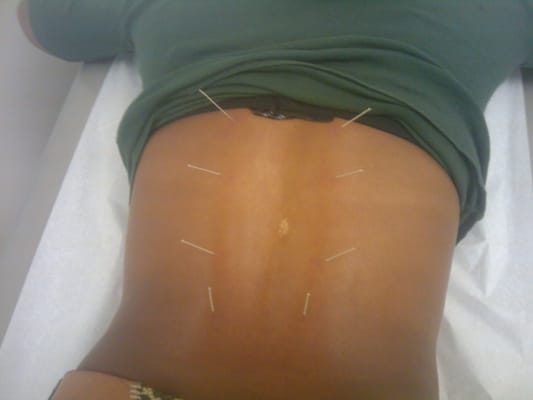 Acupuncture For Back Pain