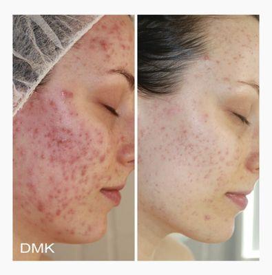 DMK Acne Skin Revision