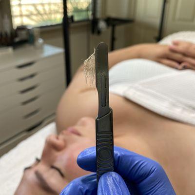 Dermaplaning