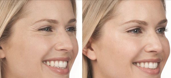 Restylane Lyft with Lidocaine 
 Fillers