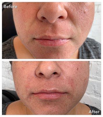 Softening deep nasolabial folds with hyaluronic acid dermal filler (before and immediately after)