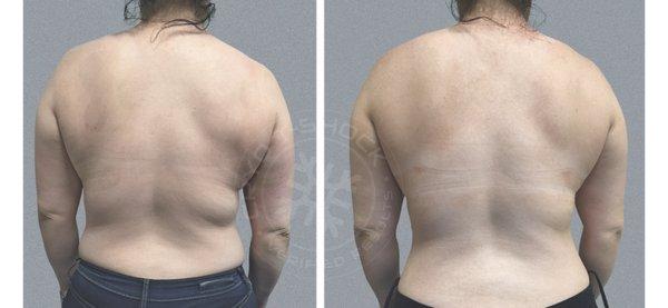 Back fat removal before and after