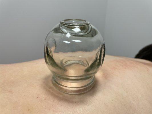 Cupping therapy available