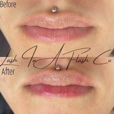 1ml lip filler