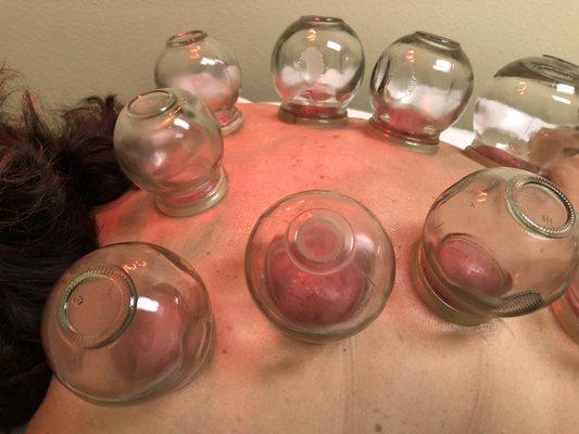 cupping