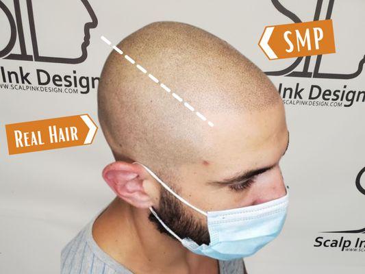 Scalp Micropigmentation Before and After - Shaved Look