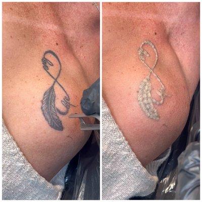 Tattoo Removal