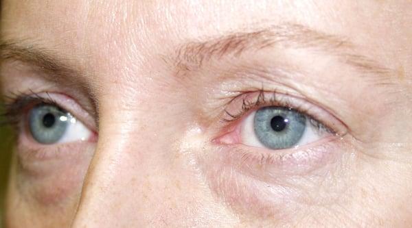 43 year old before blepharoplasty or eyelid surgery. Dr. Rosenthal