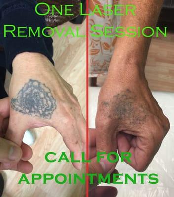 Kenosha Laser Tattoo Removal