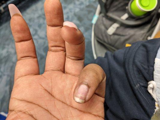 This is the nail that became swollen and painful to touch.