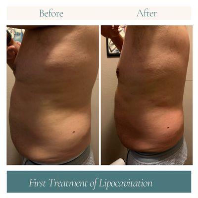 Just one treatment of lipocavitation