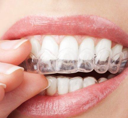 We transform smiles with Invisalign® clear aligners.