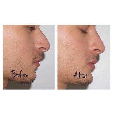 Juvederm on nose